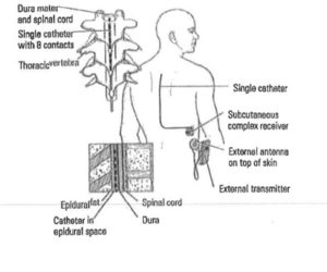 Diagram of surgically-implanted neurostimulator for spine