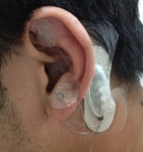 P-Stim device attached behind ear